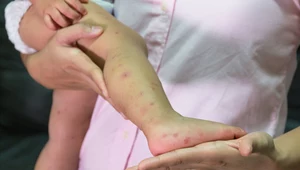 Najbardziej narażone na zakażenie są dzieci w wieku od 2 do 10 lat