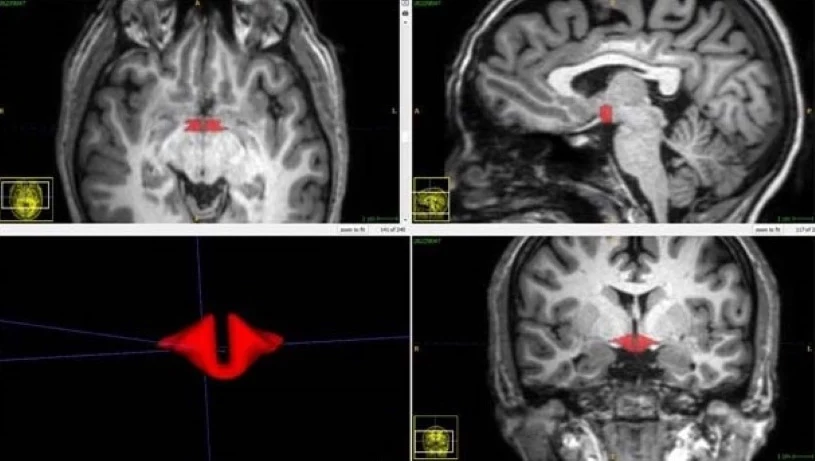 Podwzgórze (czerwone) w obrazie MRI /Michael L. Lipton, RSNA /Materiały prasowe 