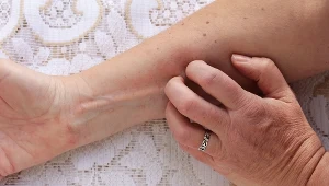 Zapomnij o suchej i szorstkiej skórze zimą. Tak przywrócisz jej gładkość