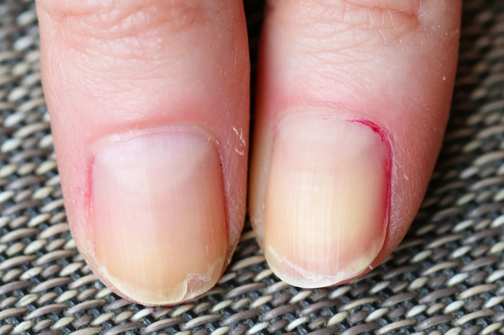 Częstą przyczyną łamliwości paznokci są niedobory witamin i składników mineralnych