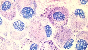 Mastocytoza - trudna do zdiagnozowania choroba nowotworowa