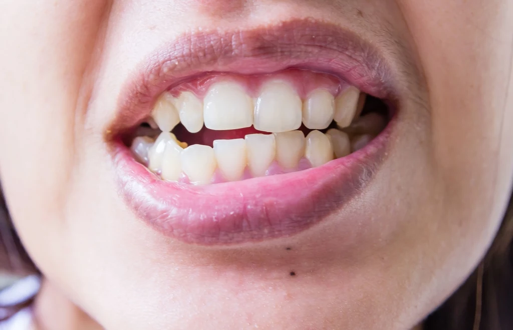 Sen o wypadających zębach może świadczyć o obniżonej pewności siebie