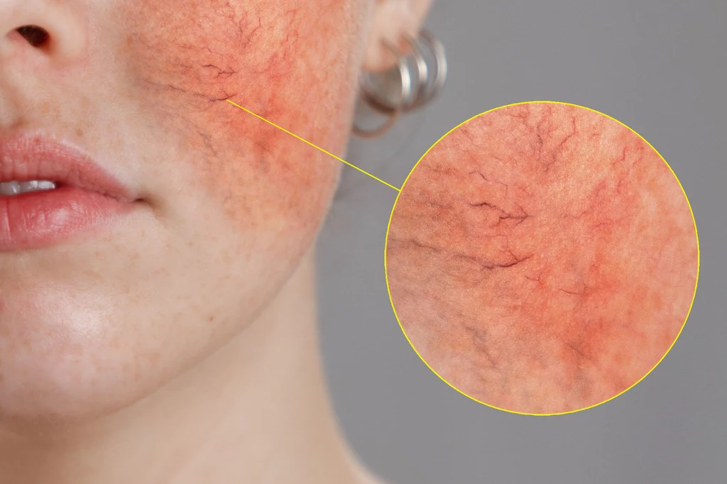 Czerwone plamy na skórze są wynikiem rozszerzonych ścian naczyń krwionośnych