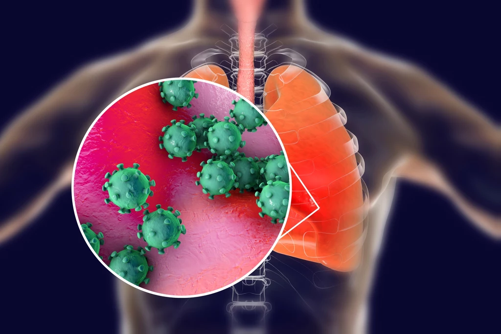 SARS-CoV-2 powoduje ostre zapalenie płuc i niewydolność oddechową