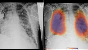 Skuteczność? 97 procent! Tomografia pomoże wykryć koronawirusa