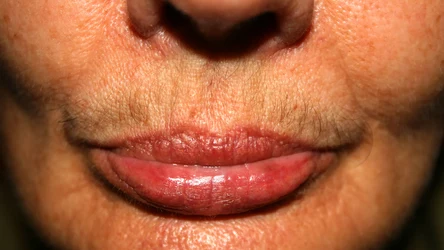 Wąsik u kobiet może powodować kompleksy. Zwłaszcza, gdy włoski są ciemne, grube i gęste