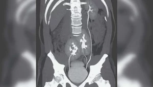 Mężczyzna z trzema nerkami