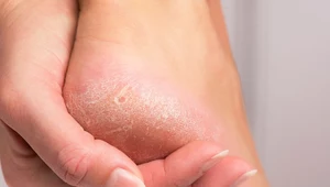 Dermatolodzy radzą, jak dbać o stopy jesienią 