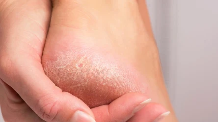 Co warto nakładać na suche pięty? 