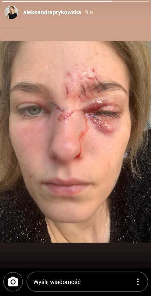 Obrażenia, jakich doznała Aleksandra Prykowska, wyglądały bardzo groźnie