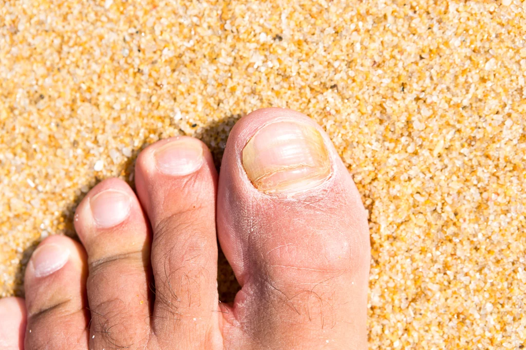 Typowym objawem grzybicy są zażółcone paznokcie