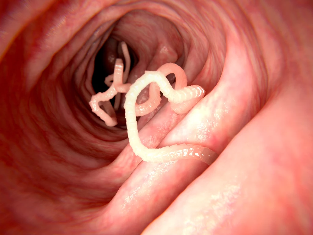Lekarze rzadko diagnozują tę chorobę, jednak wcale nie jest ona tak niespotykana Lekarze rzadko diagnozują tę chorobę, jednak wcale nie jest ona tak niespotykana