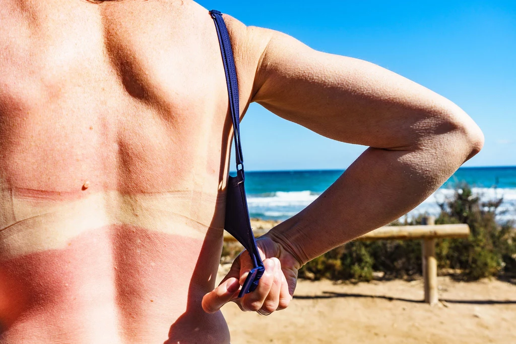 Podczas opalania należy dbać o skórę - zabezpieczać ją przed szkodliwymi promieniami słonecznymi