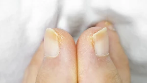 Żółte paznokcie to wstydliwy problem. Nie zawsze oznaczają tylko grzybicę!