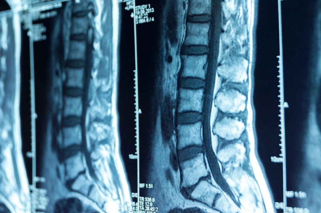 Coccygodynia może powstać też w efekcie silnego napięcia dna miednicy