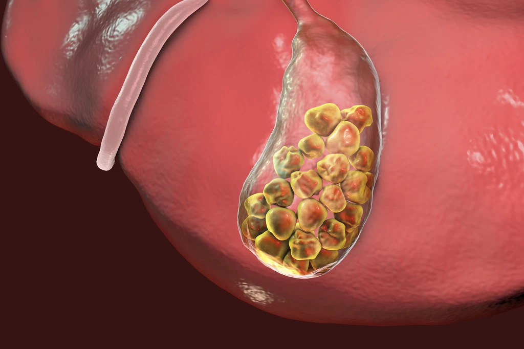 Kamienie żółciowe powstają, gdy produkowany w wątrobie cholesterol krystalizuje się