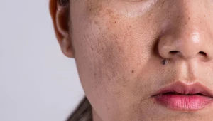 Przebarwienia na twarzy – jak z nimi walczyć?