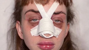 Uczestniczka "Hotelu Paradise" przeszła operację plastyczną nosa?