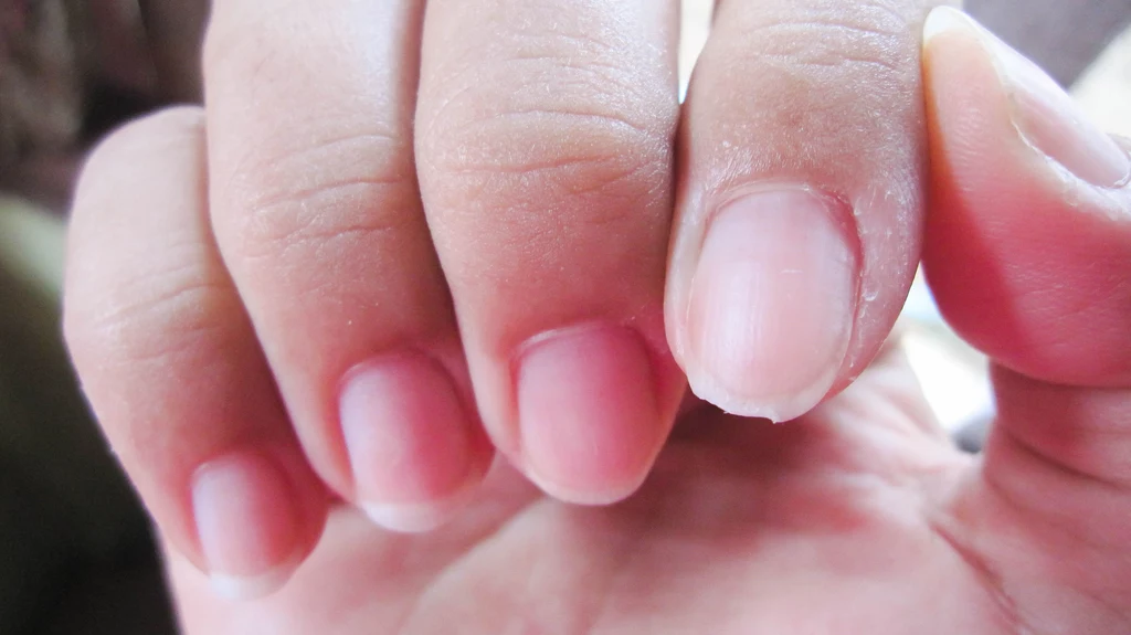 Jakie choroby można odczytać z paznokci? To znak poważnego schorzenia