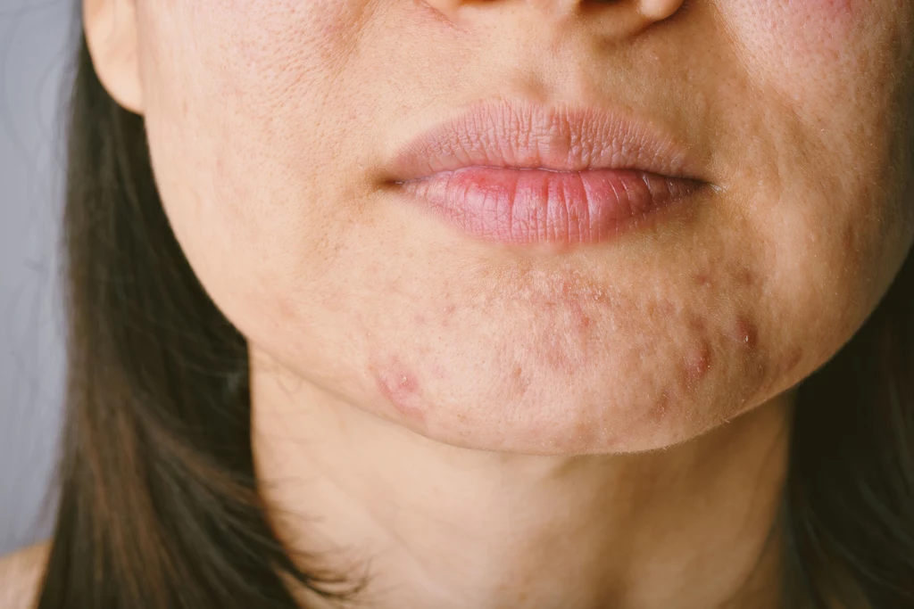 Pielęgnacja skóry tłustej powinna opierać się na skrupulatnym oczyszczaniu, ale i nawilżaniu