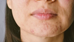 Dermatolodzy zdradzają, jakie kosmetyki szkodzą tłustej cerze