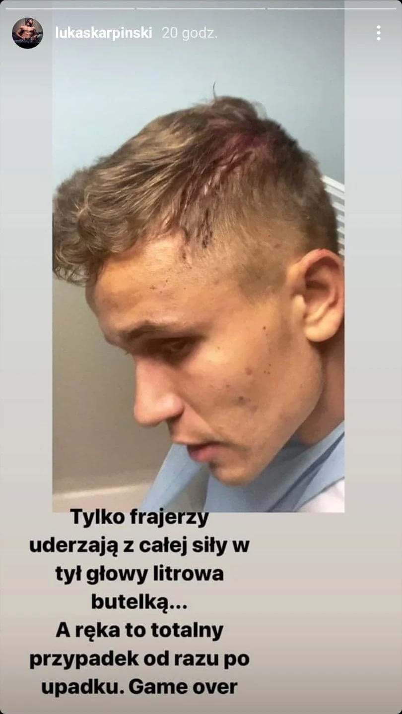 Łukasz Karpiński pokazał skutki pobicia na swoim Instagramie Łukasz Karpiński pokazał skutki pobicia na swoim Instagramie