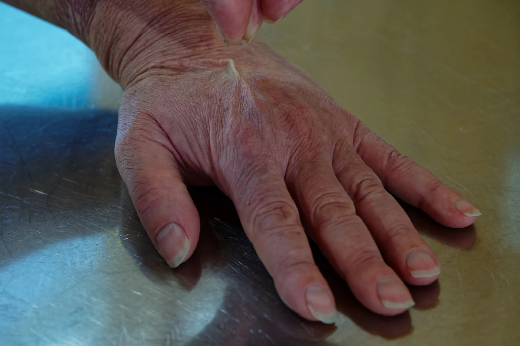 Sposobem na sprawdzenie, czy skóra jest odwodniona, jest delikatne uszczypnięcie skóry na dłoni lub policzku