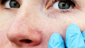 Jak objawiają się przewlekłe choroby skóry? 