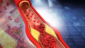 Hipercholesterolemia rodzinna: Przyczyny, objawy i leczenie