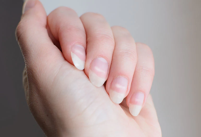 Co oznaczają białe plamy na paznokciach? 