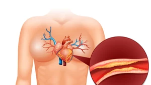 Choroba wieńcowa: Przyczyny, objawy i leczenie