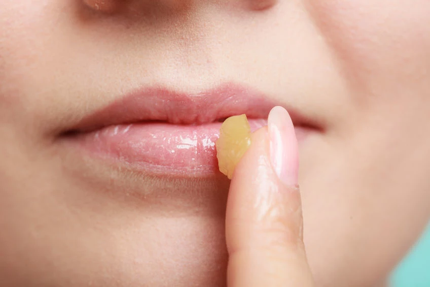 Jak walczyć ze spierzchniętymi ustami? 