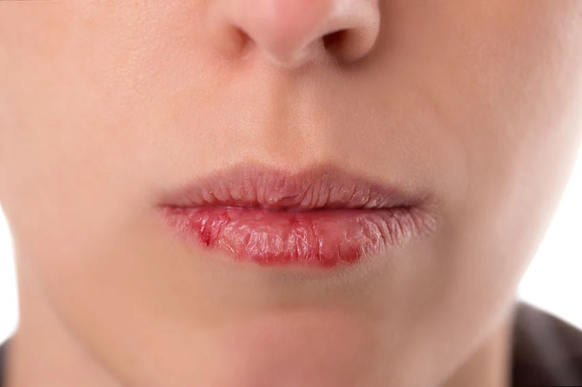 Przyczyny pękania ust 