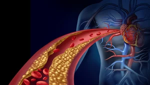 Jak uniknąć miażdżycy?  