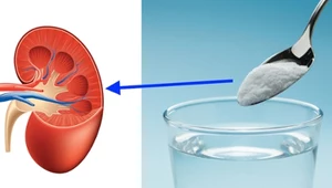 Soda oczyszczona na kamienie nerkowe - jak stosować?