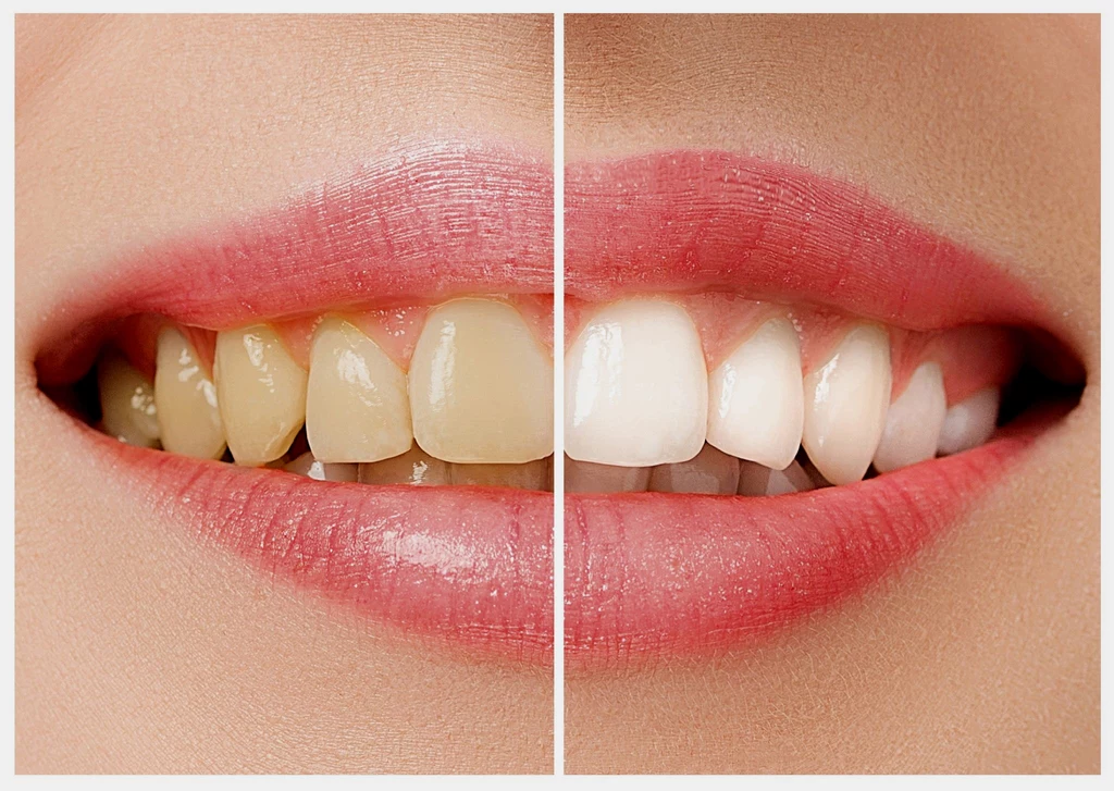 Jeżeli w ostatnim czasie wasze zęby zmieniły odcień na ciemniejszy, może mieć to związek z nieodpowiednią dietą