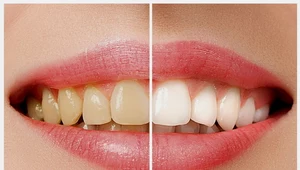Pięć domowych sposobów na bielsze zęby