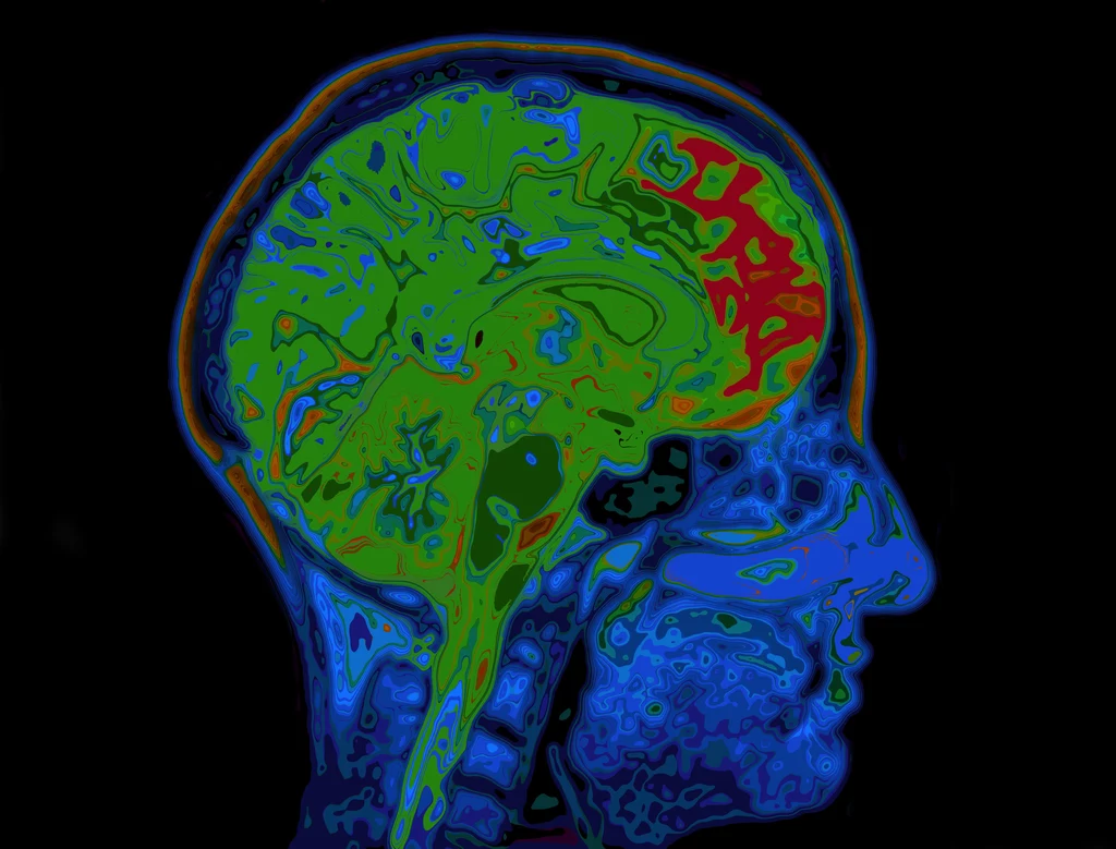 Czy u osób z COVID-19 mogą występować powikłania neurologiczne?