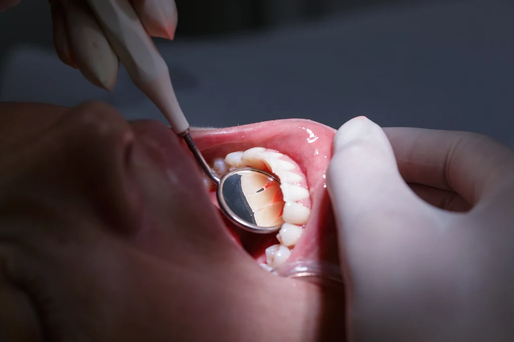 Paradontoza często atakuje zęby
