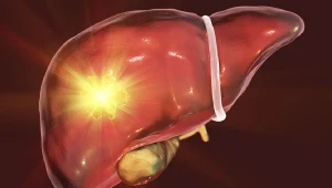 Przyczyną raka wątroby może być zakażenie wirusem HCV