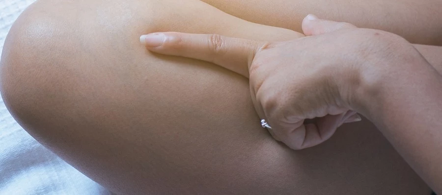 Pajączki uznawane są za defekt Pajączki uznawane są za defekt