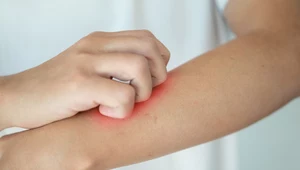Sprawdź, co poradzić na atopowe zapalenie skóry