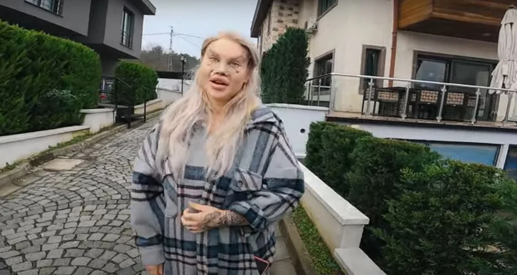 Ewelona niedługo po operacji twarzy i odsysaniu tłuszczu z okolic brzucha Ewelona niedługo po operacji twarzy i odsysaniu tłuszczu z okolic brzucha
