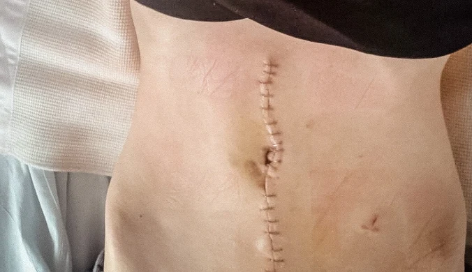 Mówili, że boli przez stres. Lata błędnych diagnoz 