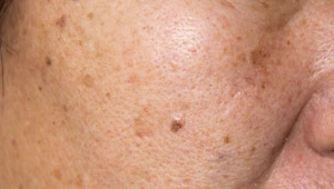 Pozbądź się przebarwień. Wystarczy produkt ze sklepu spożywczego za 1,50 zł