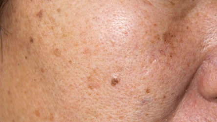 Przebarwienia na skórze są efektem nierównomiernego nagromadzenia melaniny