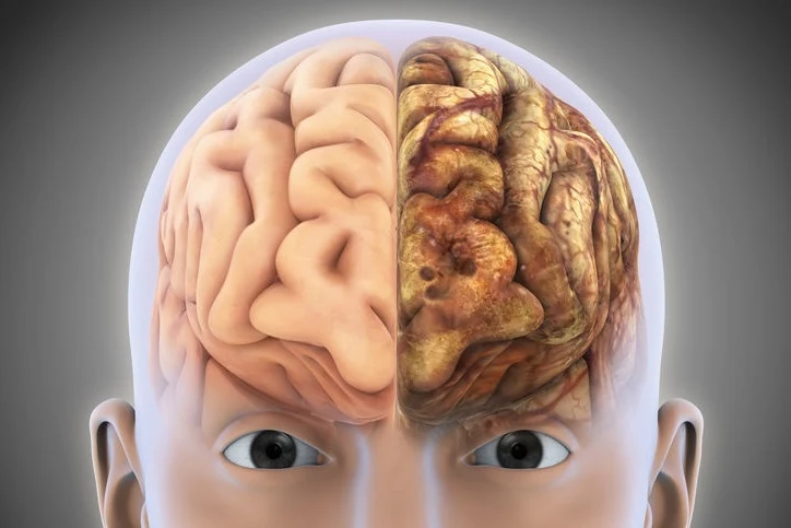 Mgła mózgowa może być objawem poważnych chorób, np. alzheimera
