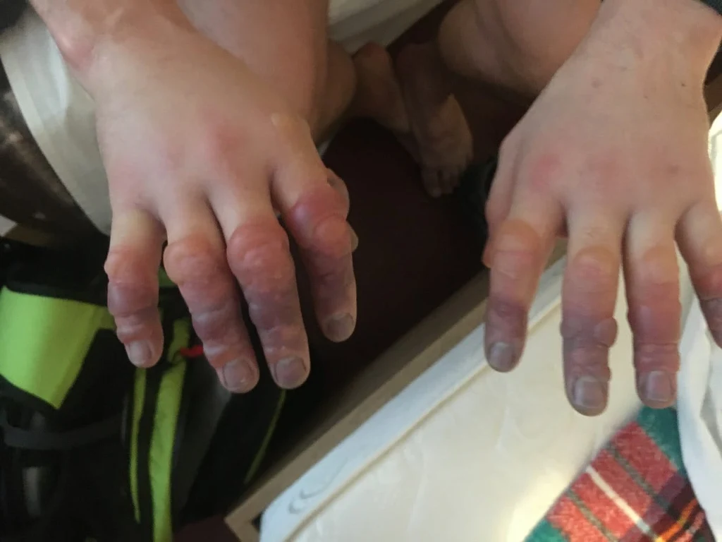 Zdjęcie odmrożonych dłoni zamieszczone przez ratowników GOPR-u. Jak mówią, ku przestrodze. Zdjęcie odmrożonych dłoni zamieszczone przez ratowników GOPR-u. Jak mówią, ku przestrodze.