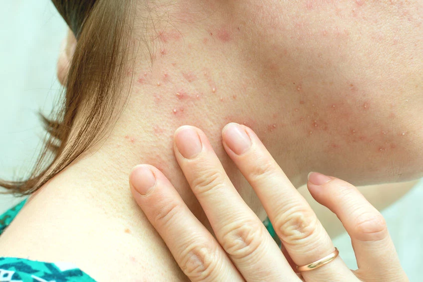 Objawy alergii skórnej można zniwelować za pomocą domowych maseczek