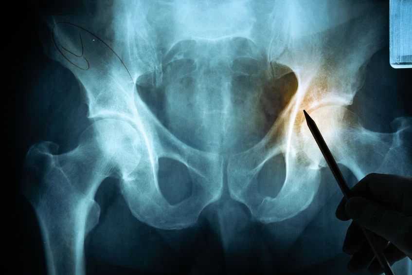 Diagnostyka reaktywnego zapalenia stawów
